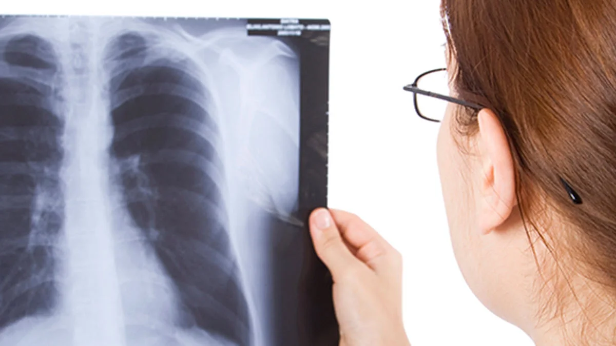 Atención con la tuberculosis.