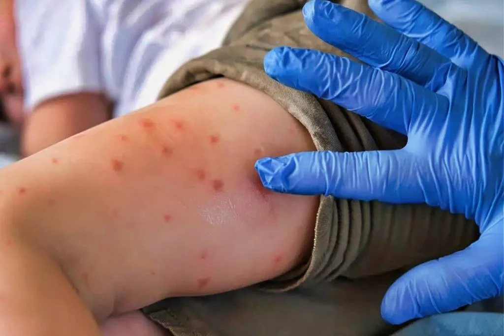 ¿Por qué no vacunan a personas mayores de 50 contra el sarampión?¿Por qué no vacunan a personas mayores de 50 contra el sarampión?