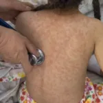 Alerta por incremento de casos de sarampión.