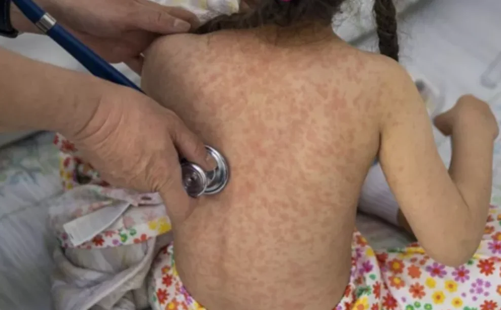 Alerta por incremento de casos de sarampión.