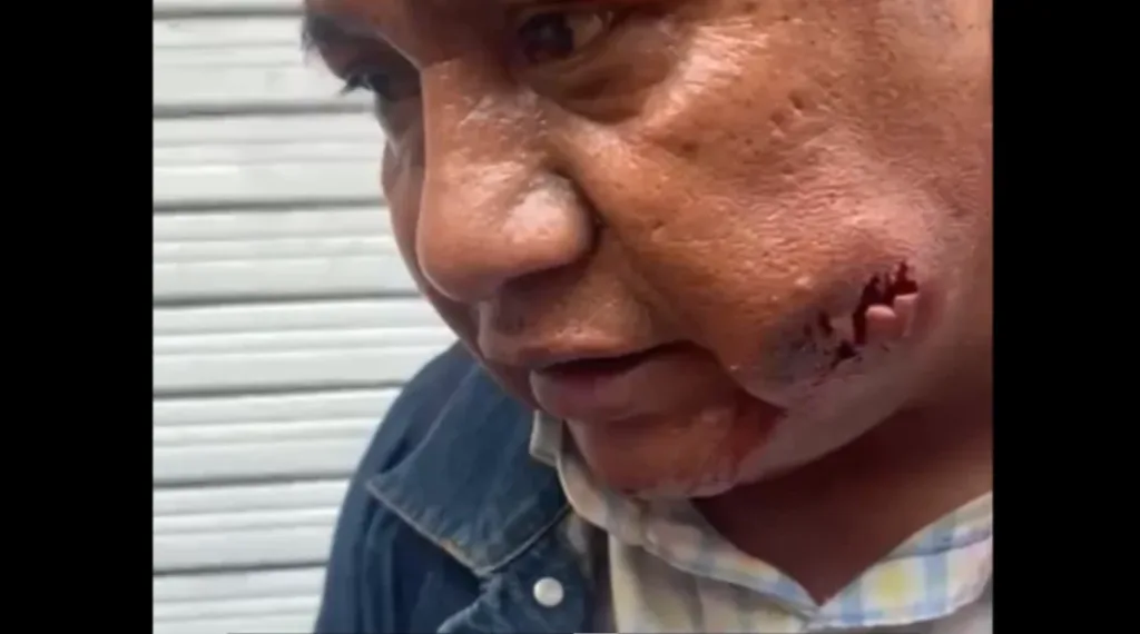 El maestro lesionado por cohetón o proyectil.