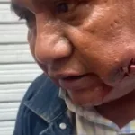 El maestro lesionado por cohetón o proyectil.